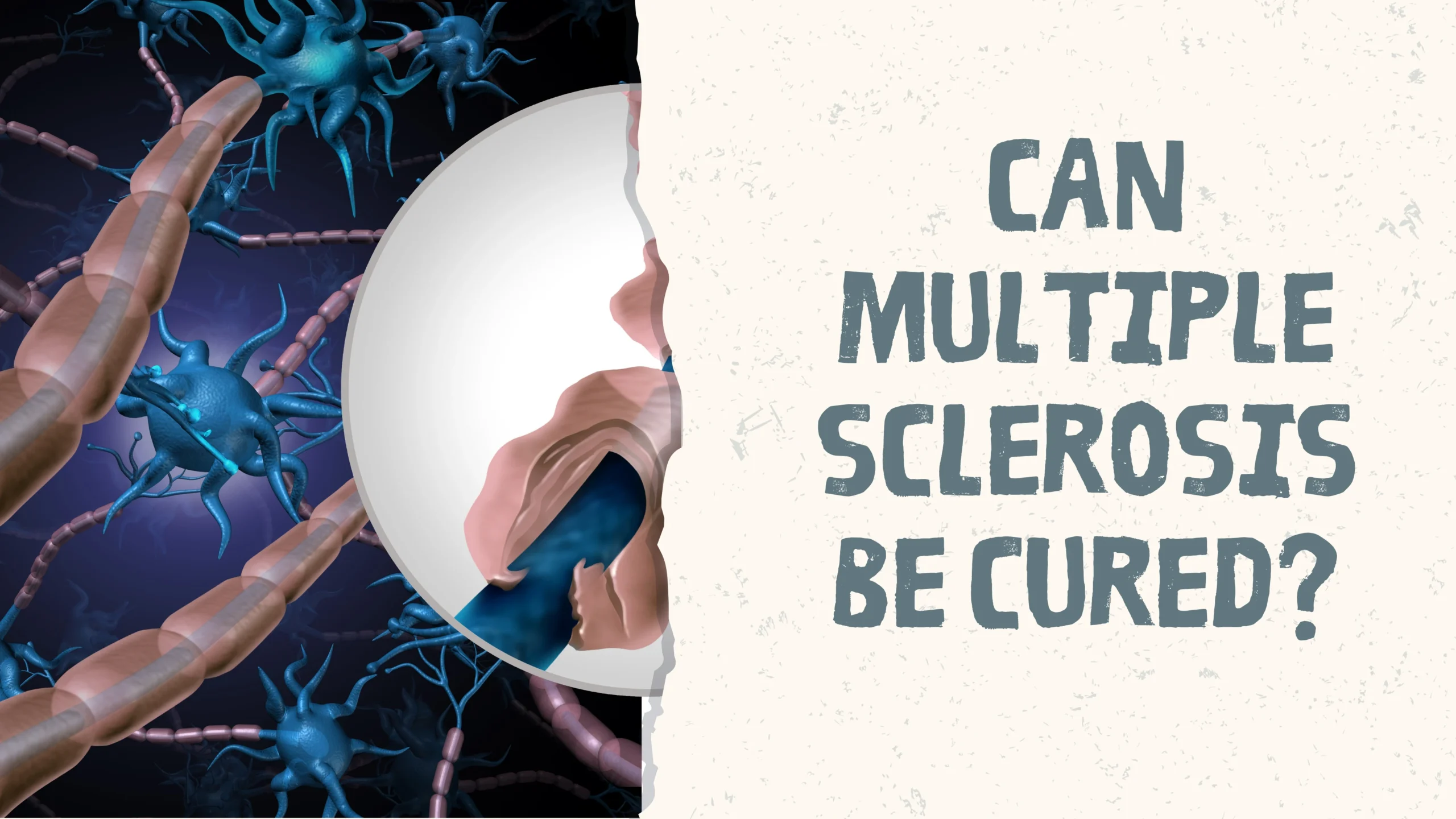 Can Multiple Sclerosis Be Cured?